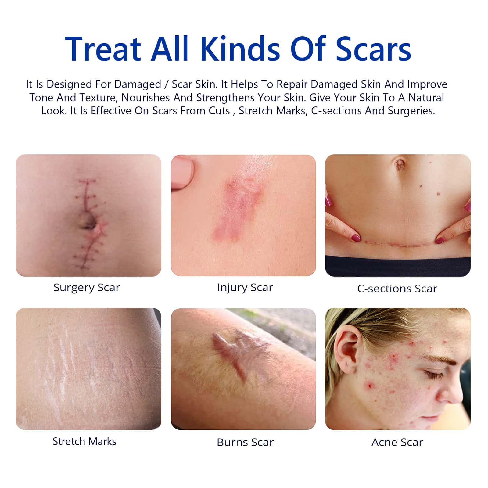 ELAIMEI's new pressed scar cream scar desalination cream 50ML.